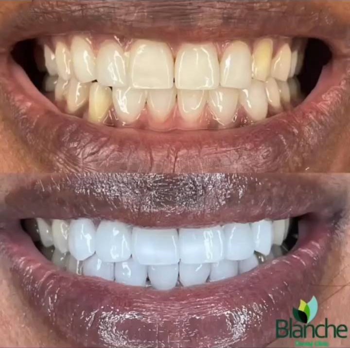 An image of a concluded Dental Veneer procedure at Blanche Dental Clinic Lagos
