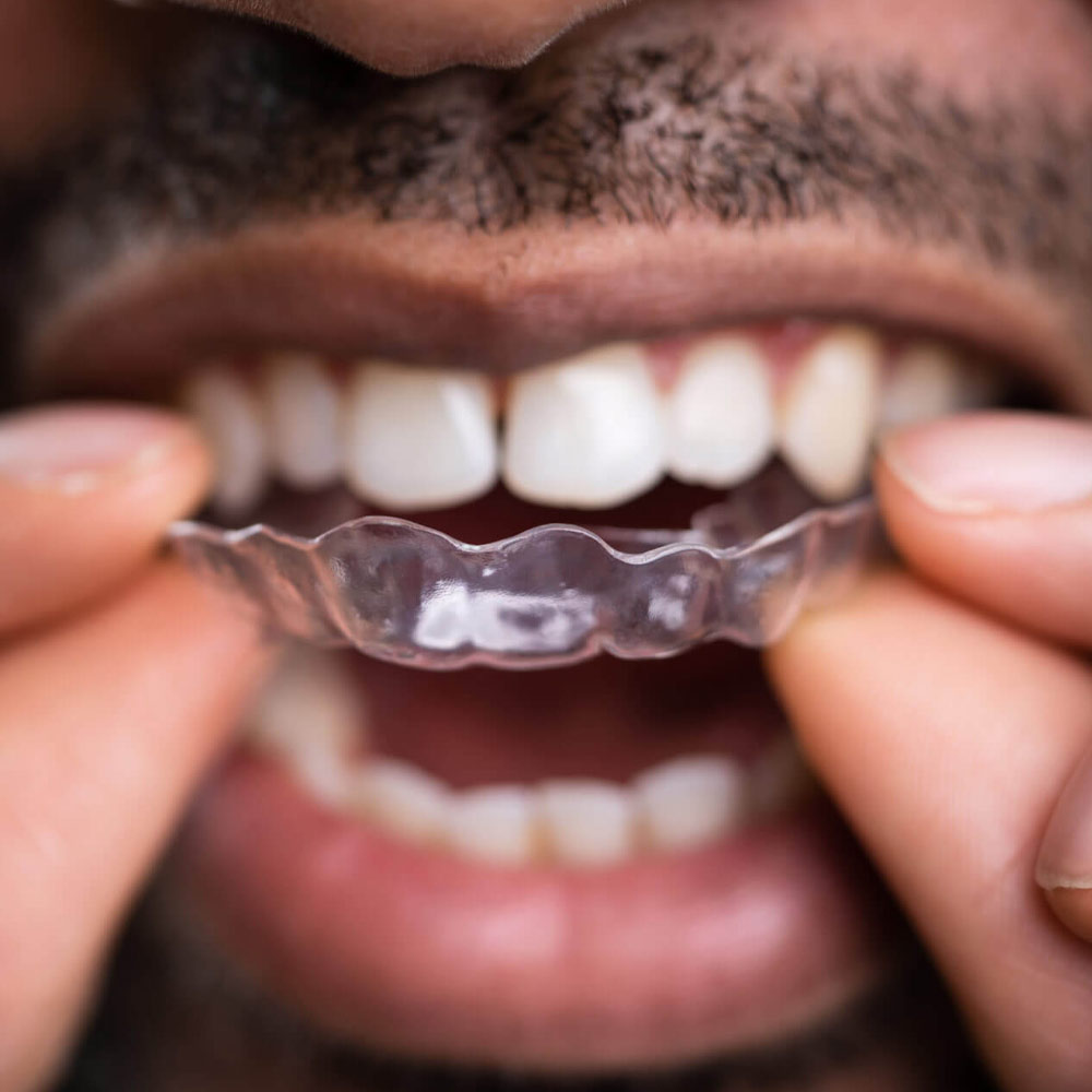 A man fixes his Dental Aligners onto his Teeth.