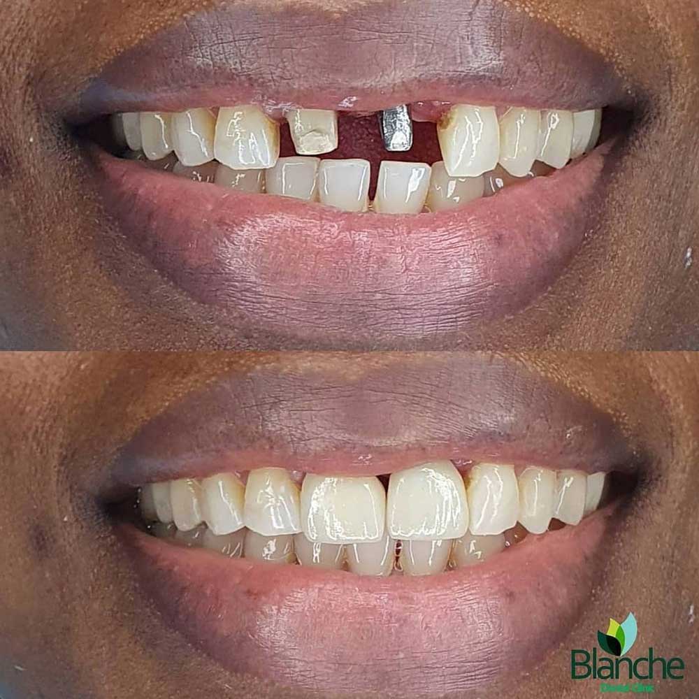 Before and After of a patient who just undergone a Dental Implant.