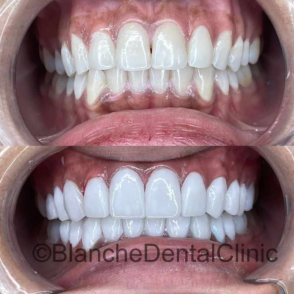 A patient displays her Dental Cavity after completion of a Dental Veneer process