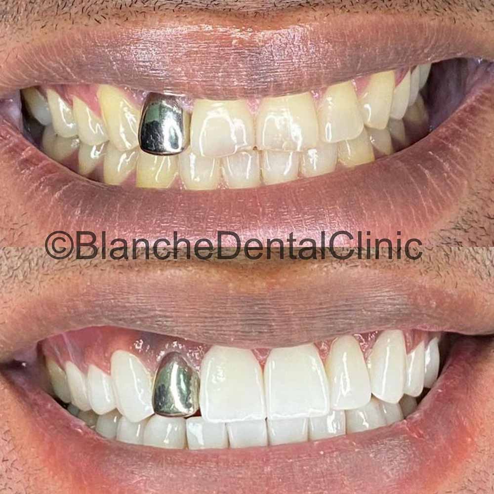 A Happy Dental patient at Blanche Dental clinic