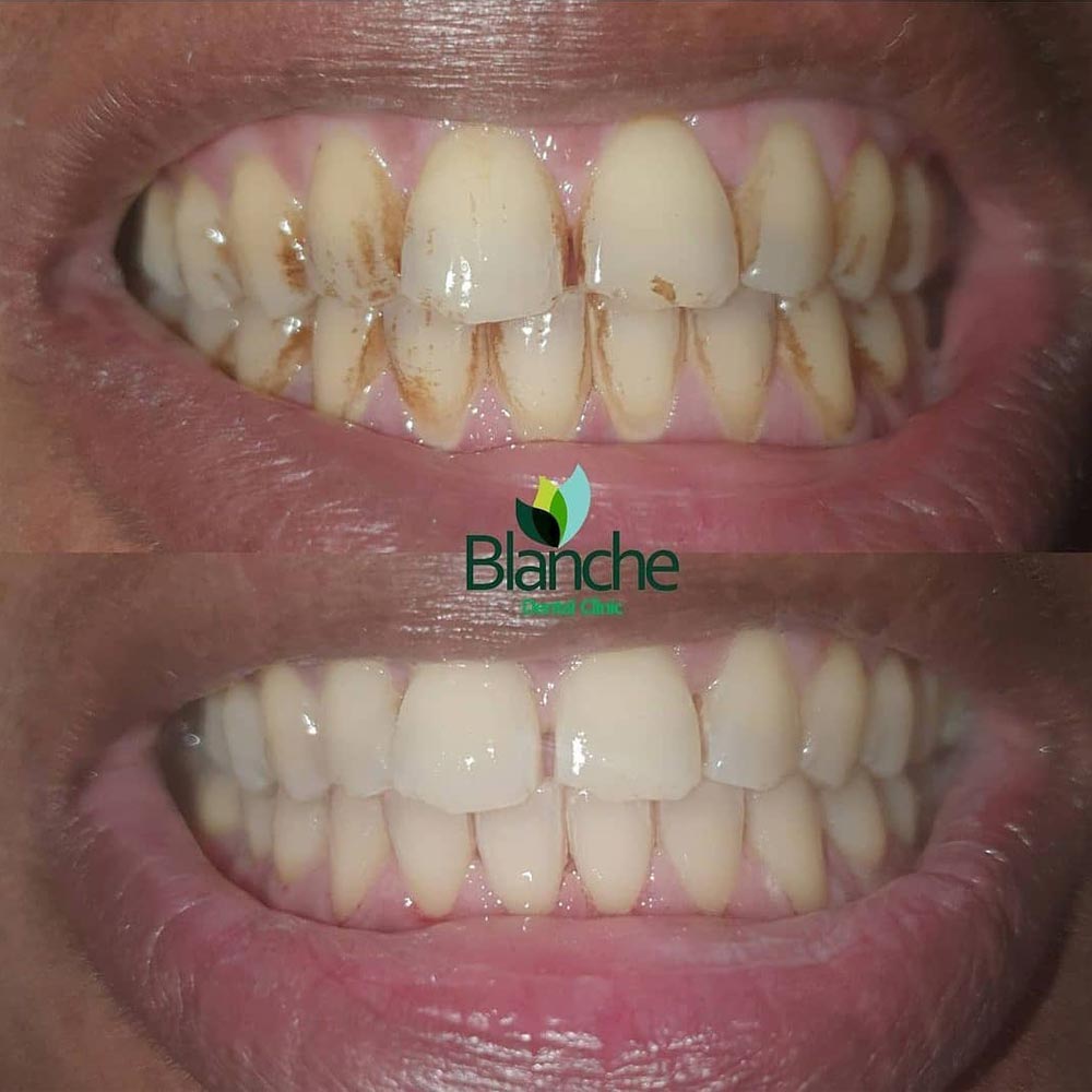 A patient shows his teeth after completion of the Scaling and Polishing procedure