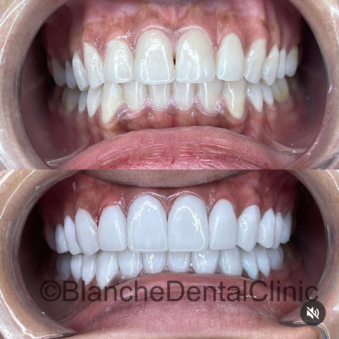 Before and After Picture of a Veneer patient